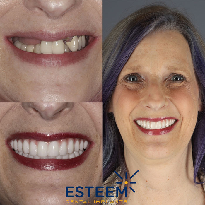 esteem before and after case