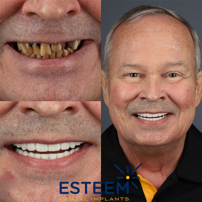 esteem before and after case