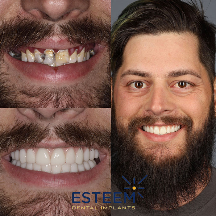 esteem before and after case