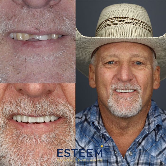 esteem before and after case